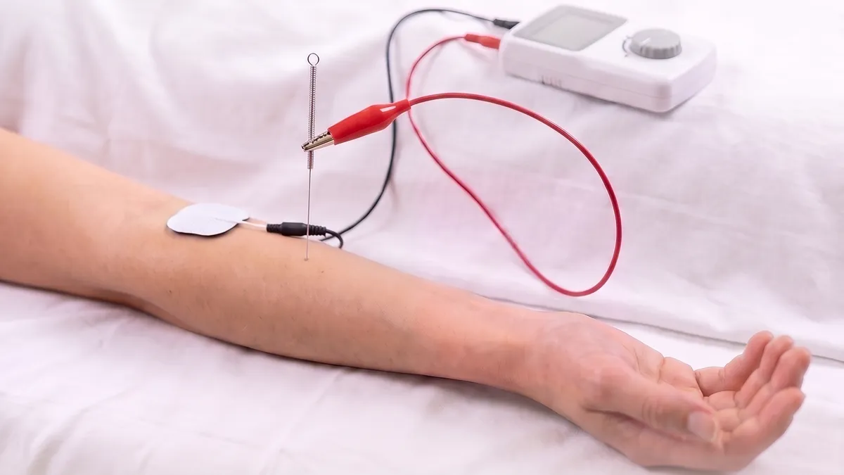 Aguja de punción en el antebrazo conectada con una pinza a un electroestimulador, con un electrodo de superficie como retorno